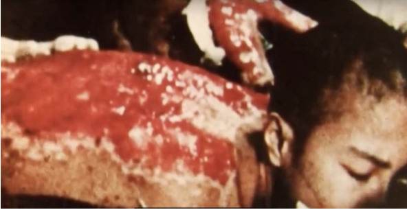 An image of a severely burned victim of the Hiroshima atomic blast