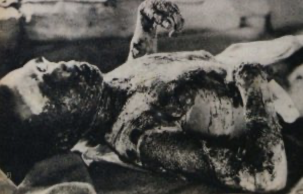 An image of a victim burned in the Hiroshima atomic blast